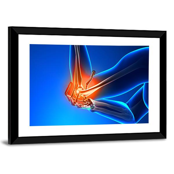 Elbow Pain Illustration Canvas Wall Art-3 Horizontal-Gallery Wrap-25" x 16"-Tiaracle