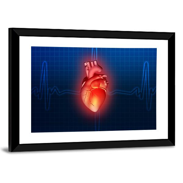 Heart Disease Illustration Canvas Wall Art-3 Horizontal-Gallery Wrap-25" x 16"-Tiaracle
