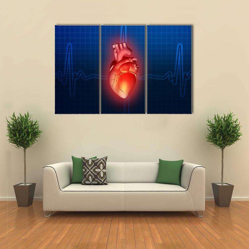 Heart Disease Illustration Canvas Wall Art-3 Horizontal-Gallery Wrap-37&quot; x 24&quot;-Tiaracle