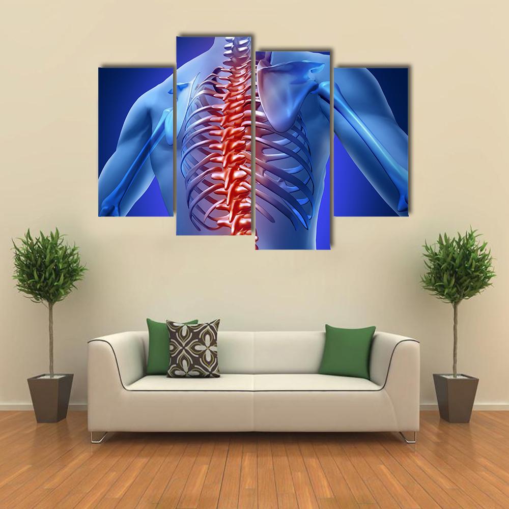 Human Backache &amp; Back Pain Canvas Wall Art-4 Pop-Gallery Wrap-34" x 20"-Tiaracle