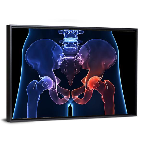 Human Painful Hip Canvas Wall Art-3 Horizontal-Gallery Wrap-25" x 16"-Tiaracle