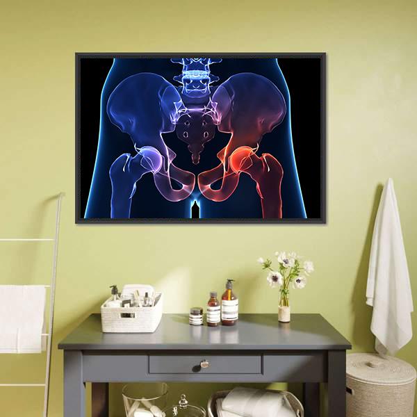 Human Painful Hip Canvas Wall Art-1 Piece-Floating Frame-24" x 16"-Tiaracle