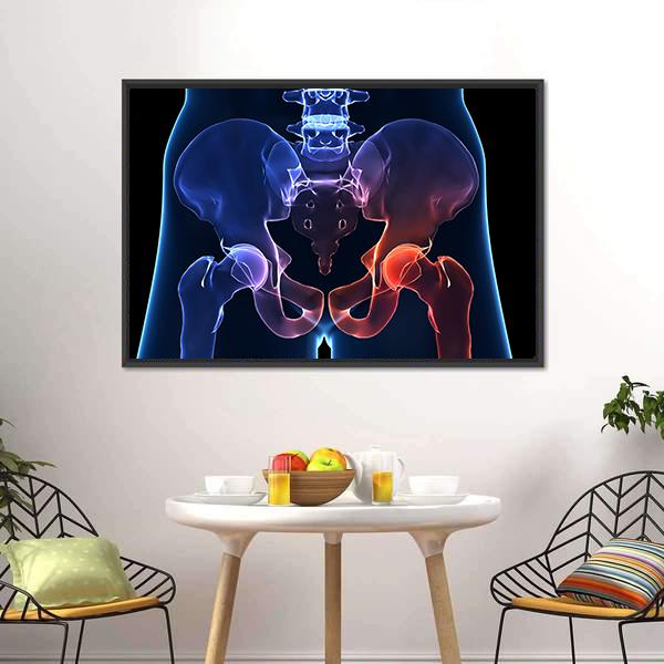Human Painful Hip Canvas Wall Art-3 Horizontal-Gallery Wrap-25" x 16"-Tiaracle