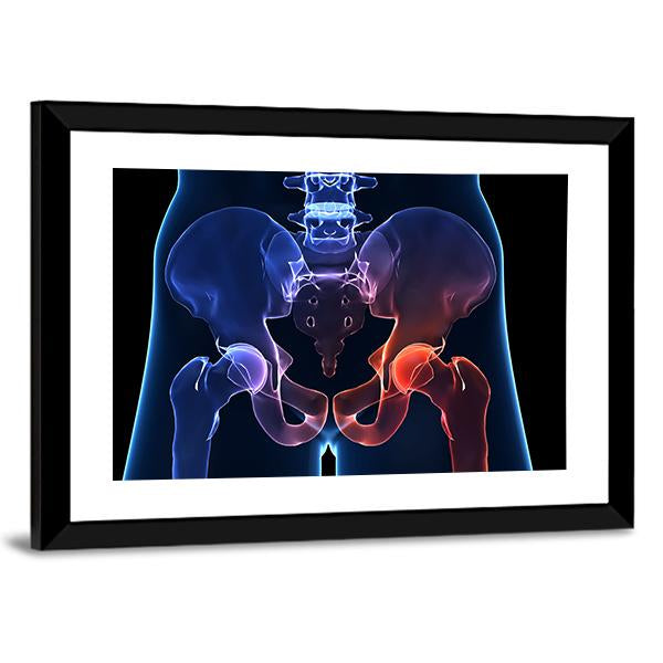 Human Painful Hip Canvas Wall Art-5 Horizontal-Gallery Wrap-22" x 12"-Tiaracle