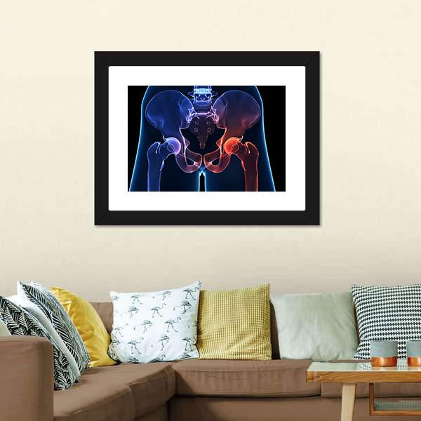 Human Painful Hip Canvas Wall Art-5 Horizontal-Gallery Wrap-22" x 12"-Tiaracle