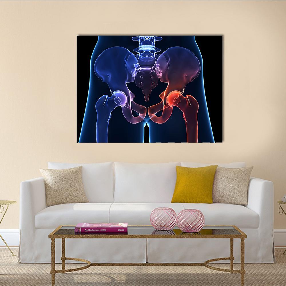 Human Hip Pain Anatomy Canvas Wall Art in black, red and blue, single panel hung on a wall