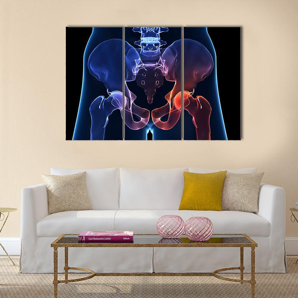 Human Painful Hip Canvas Wall Art-3 Horizontal-Gallery Wrap-37" x 24"-Tiaracle