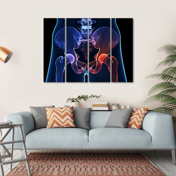 Human Painful Hip Canvas Wall Art-4 Horizontal-Gallery Wrap-34" x 24"-Tiaracle