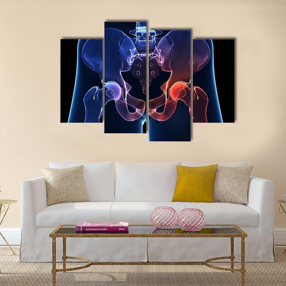 Human Painful Hip Canvas Wall Art-4 Pop-Gallery Wrap-50" x 32"-Tiaracle