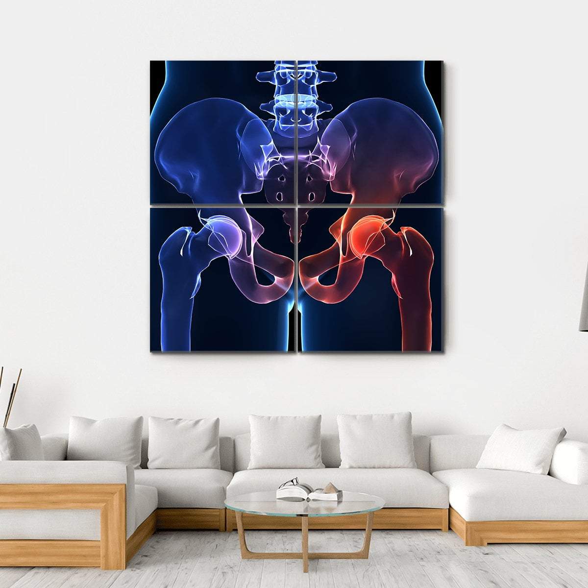 Human Painful Hip Canvas Wall Art-4 Square-Gallery Wrap-17" x 17"-Tiaracle