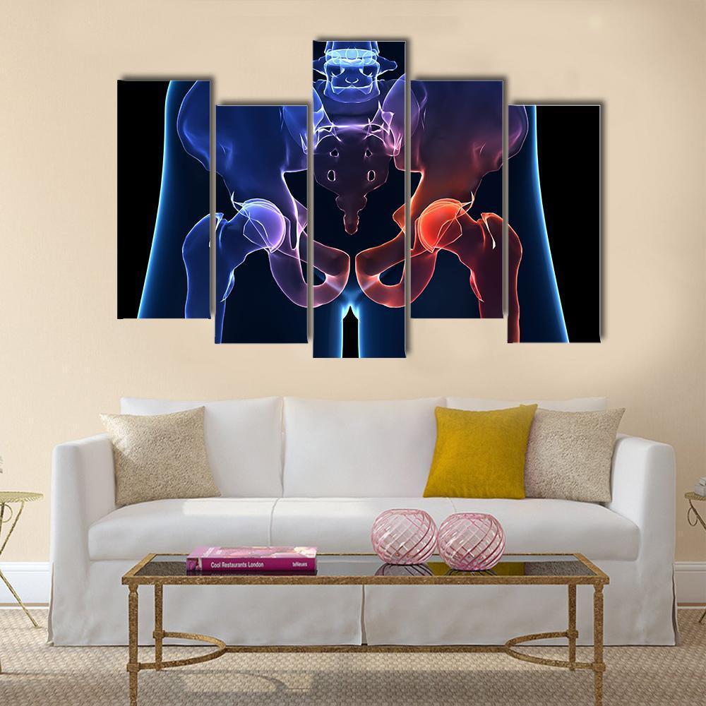 Human Painful Hip Canvas Wall Art-5 Pop-Gallery Wrap-47" x 32"-Tiaracle