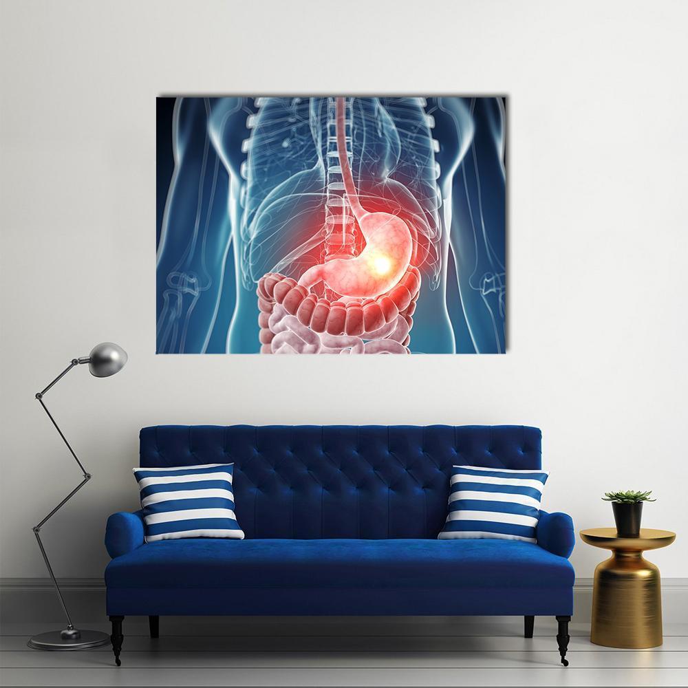 Illustration Of Painful Stomach Canvas Wall Art-1 Piece-Gallery Wrap-48" x 32"-Tiaracle