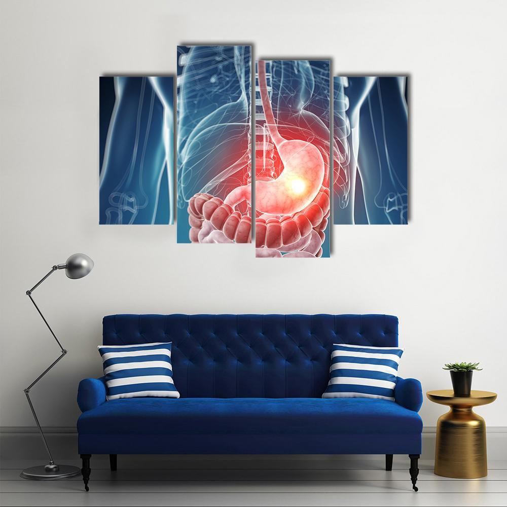 Illustration Of Painful Stomach Canvas Wall Art-4 Pop-Gallery Wrap-50" x 32"-Tiaracle