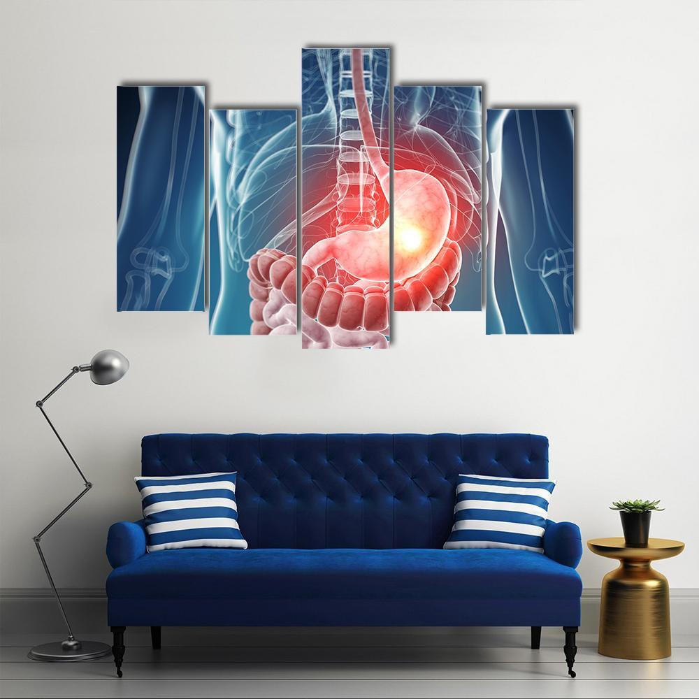 Illustration Of Painful Stomach Canvas Wall Art-5 Pop-Gallery Wrap-47" x 32"-Tiaracle