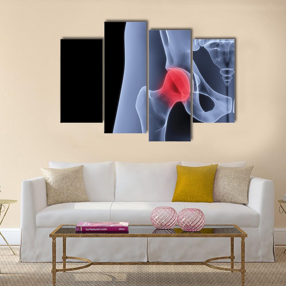 X-Rays Of Pelvis Canvas Wall Art-4 Pop-Gallery Wrap-50" x 32"-Tiaracle