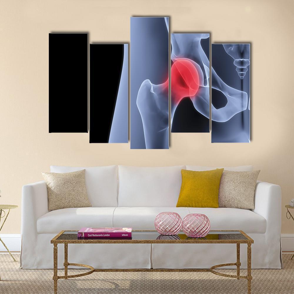 X-Rays Of Pelvis Canvas Wall Art-5 Pop-Gallery Wrap-47" x 32"-Tiaracle