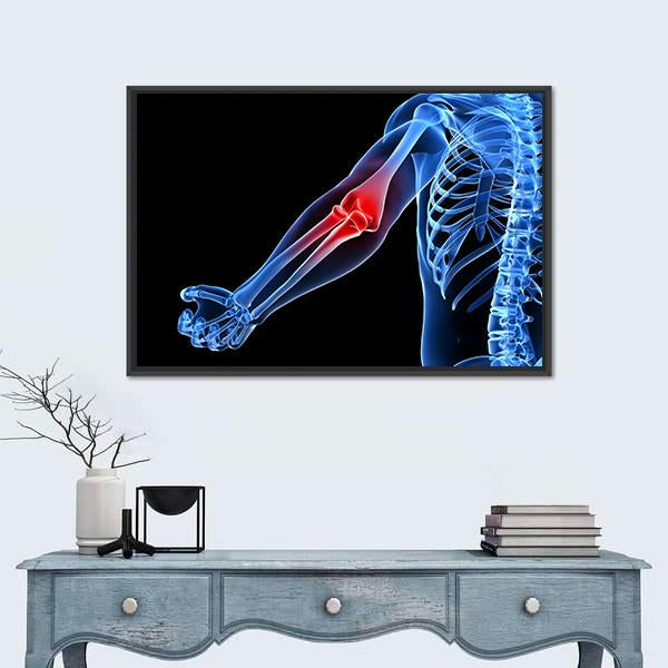 Painful Elbow Medical Illustration Canvas Wall Art in black, red and blue, framed canvas, product view on a white background