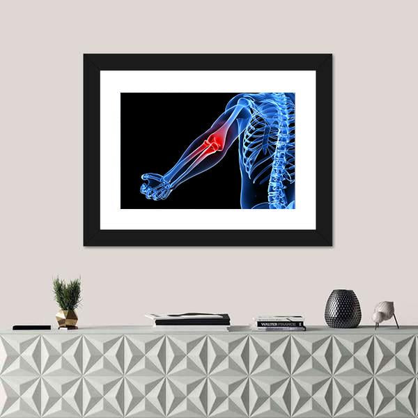 Painful Elbow Illustration Canvas Wall Art-1 Piece-Framed Print-20&quot; x 16&quot;-Tiaracle