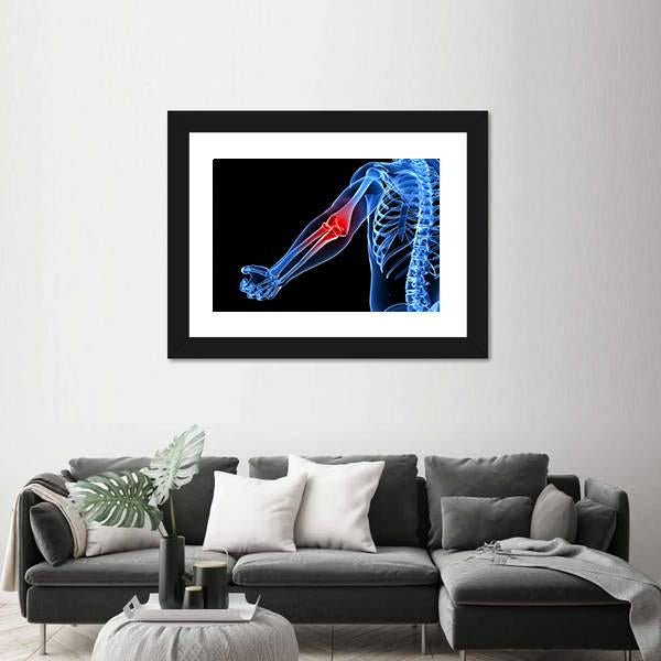 Painful Elbow Illustration Canvas Wall Art-3 Horizontal-Gallery Wrap-25" x 16"-Tiaracle