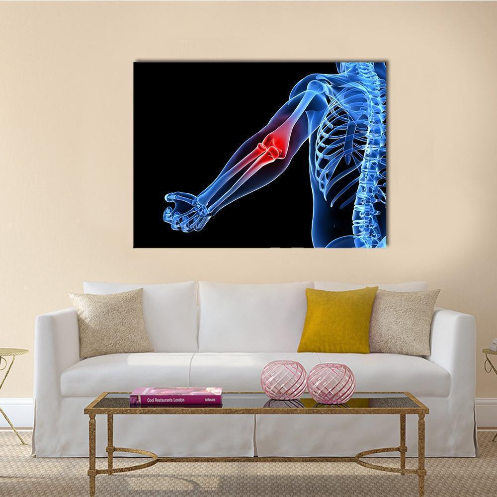 Painful Elbow Medical Illustration Canvas Wall Art in black, red and blue, single panel hung on a wall