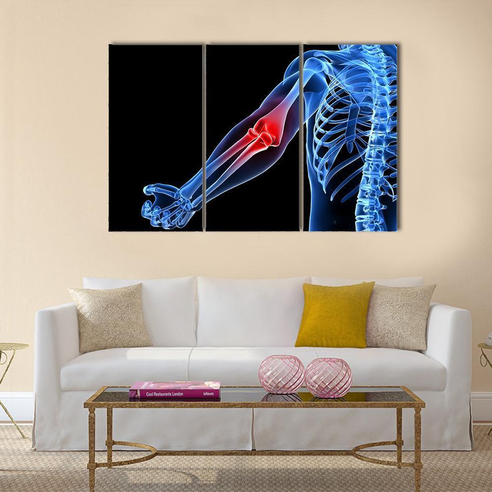 Painful Elbow Illustration Canvas Wall Art-3 Horizontal-Gallery Wrap-37&quot; x 24&quot;-Tiaracle