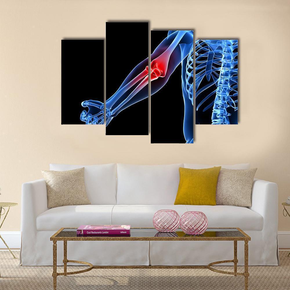 Painful Elbow Illustration Canvas Wall Art-4 Pop-Gallery Wrap-50&quot; x 32&quot;-Tiaracle