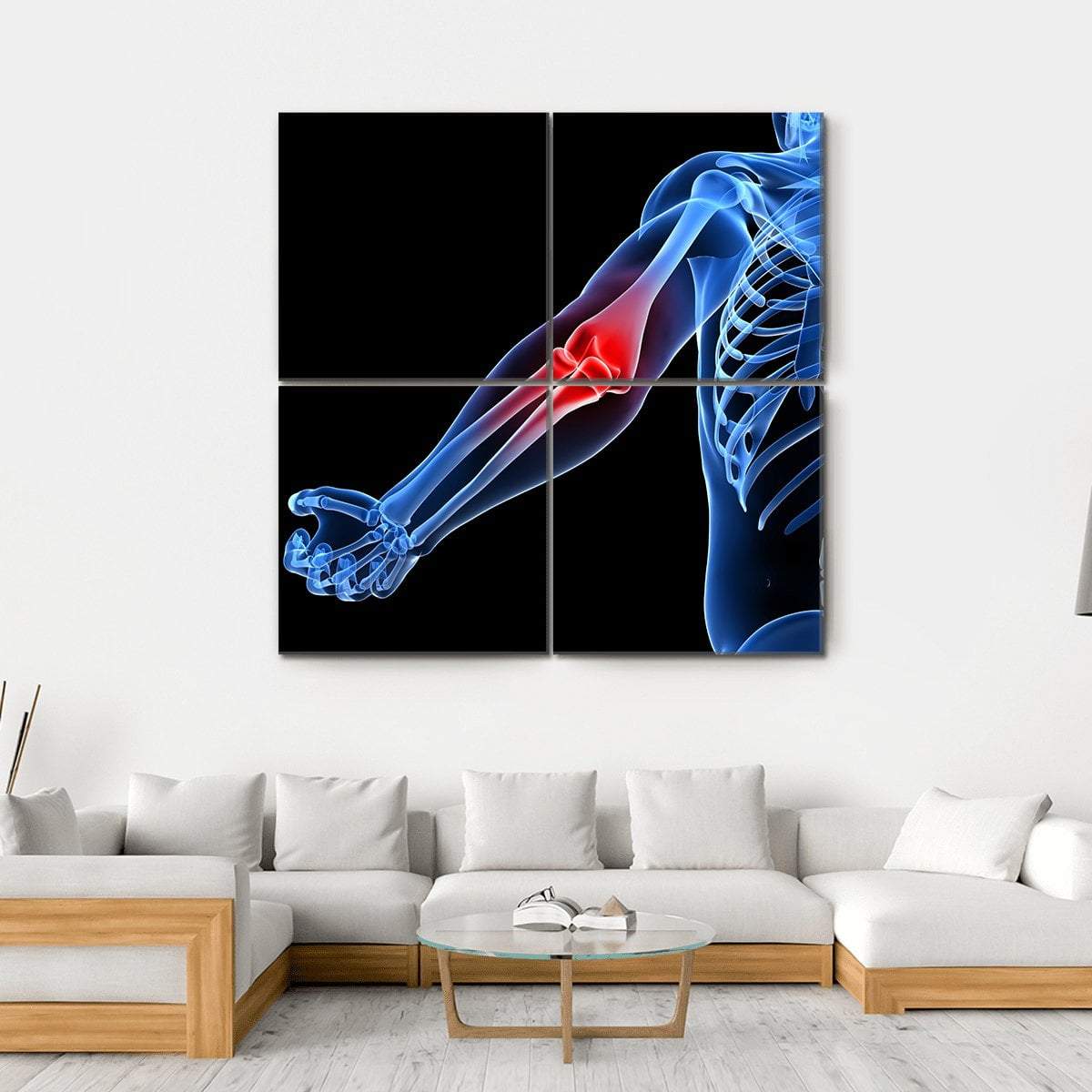 Painful Elbow Illustration Canvas Wall Art-4 Square-Gallery Wrap-17" x 17"-Tiaracle