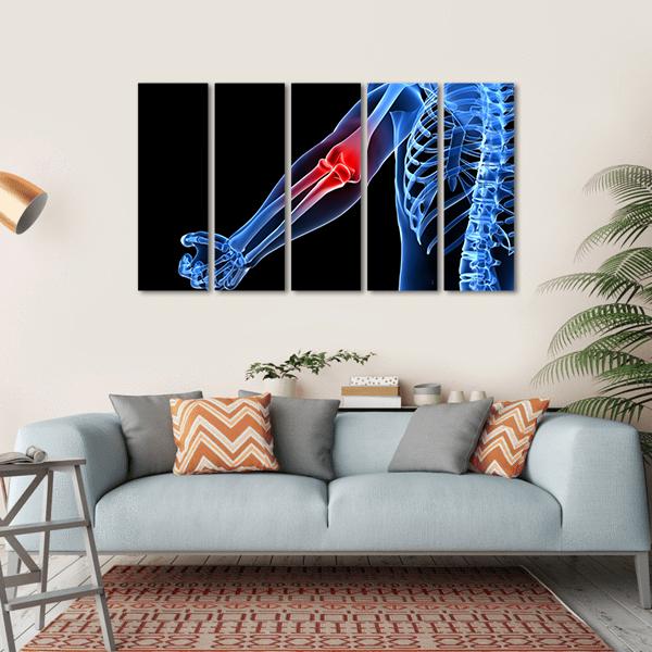 Painful Elbow Illustration Canvas Wall Art-5 Horizontal-Gallery Wrap-22" x 12"-Tiaracle