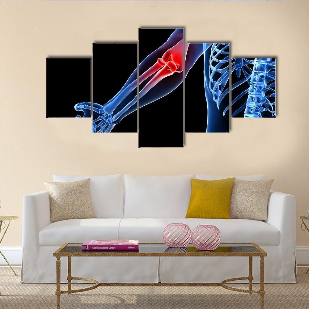 Painful Elbow Illustration Canvas Wall Art-5 Star-Gallery Wrap-62&quot; x 32&quot;-Tiaracle