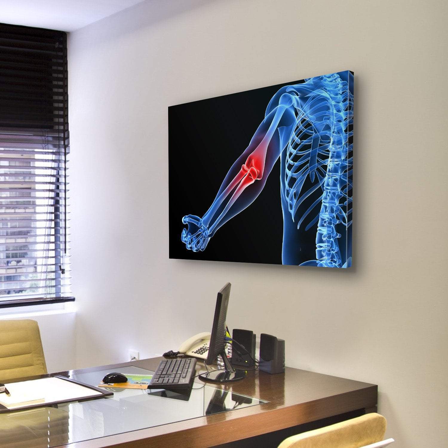 Painful Elbow Illustration Canvas Wall Art-3 Horizontal-Gallery Wrap-25" x 16"-Tiaracle