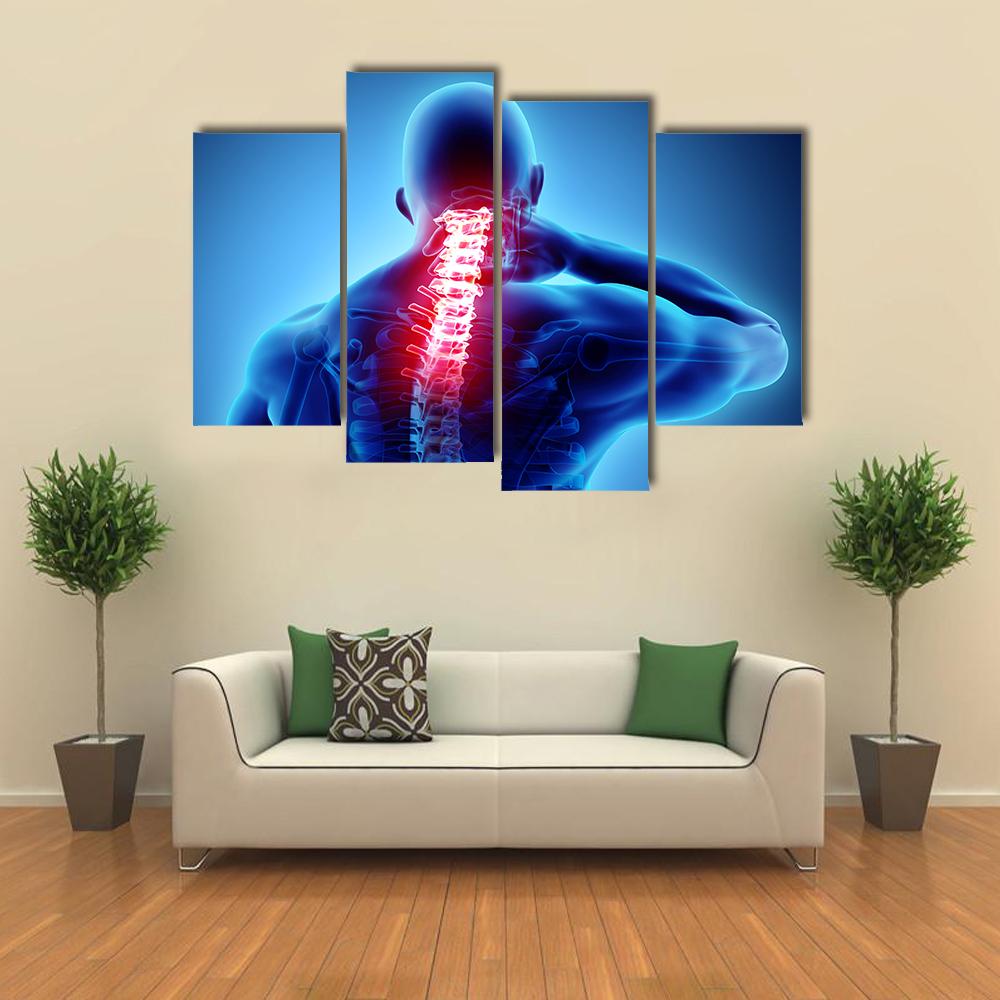 Painful Neck With Cervical Spine Skeleton X-Ray Canvas Wall Art-4 Pop-Gallery Wrap-34" x 20"-Tiaracle