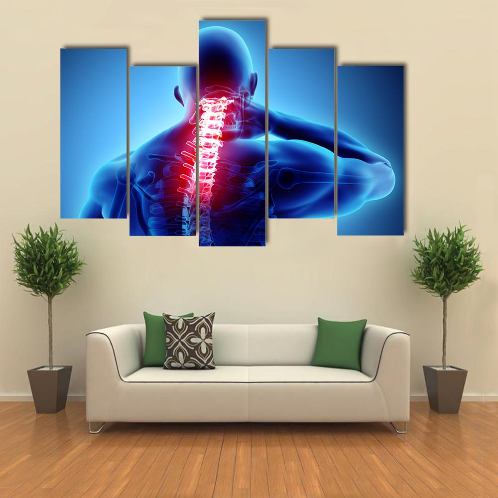 Painful Neck With Cervical Spine Skeleton X-Ray Canvas Wall Art-5 Pop-Gallery Wrap-32" x 21"-Tiaracle