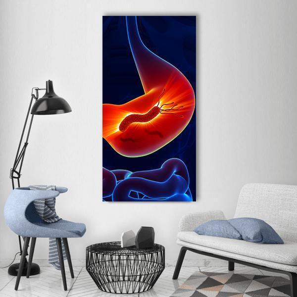 Inflamed Stomach with H. Pylori Illustration Vertical Canvas Wall Art in red, orange and blue, single vertical panel hung on a wall