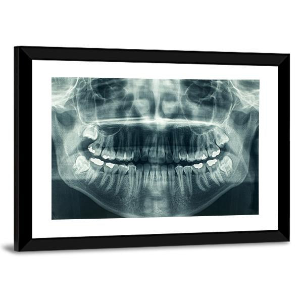 Dental X-Ray Canvas Wall Art-3 Horizontal-Gallery Wrap-25&quot; x 16&quot;-Tiaracle