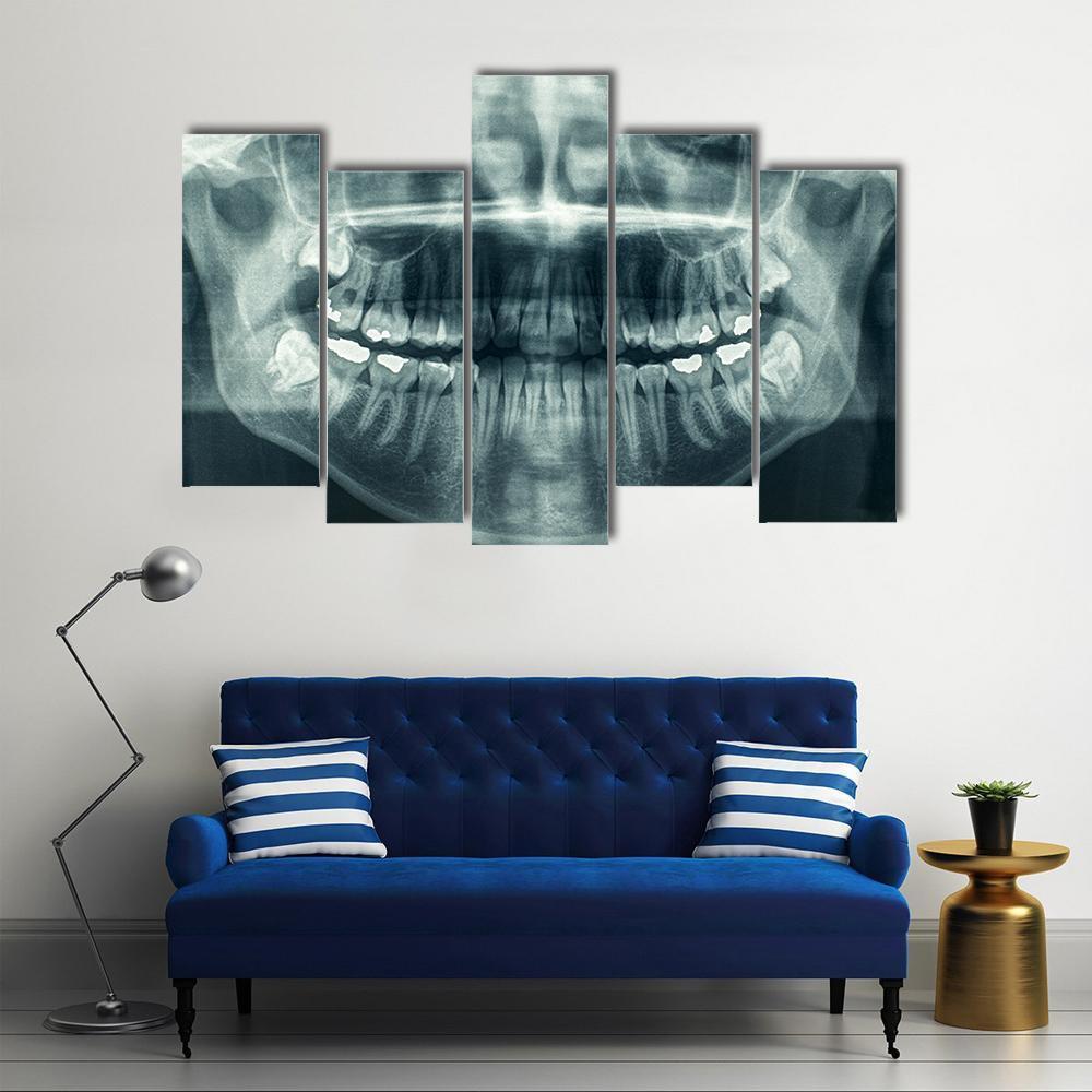 Dental X-Ray Canvas Wall Art-5 Pop-Gallery Wrap-47" x 32"-Tiaracle
