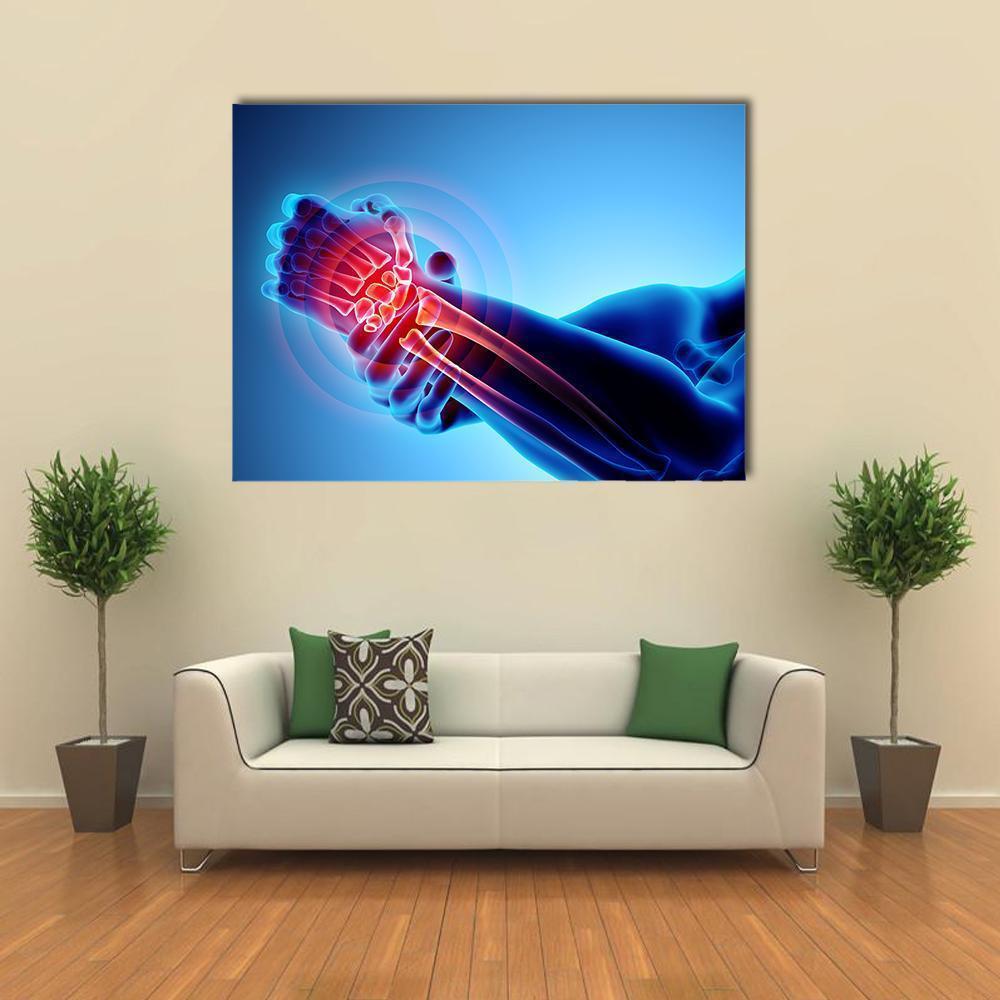 Wrist Painful Skeleton X-Ray Canvas Wall Art-4 Horizontal-Gallery Wrap-34" x 24"-Tiaracle