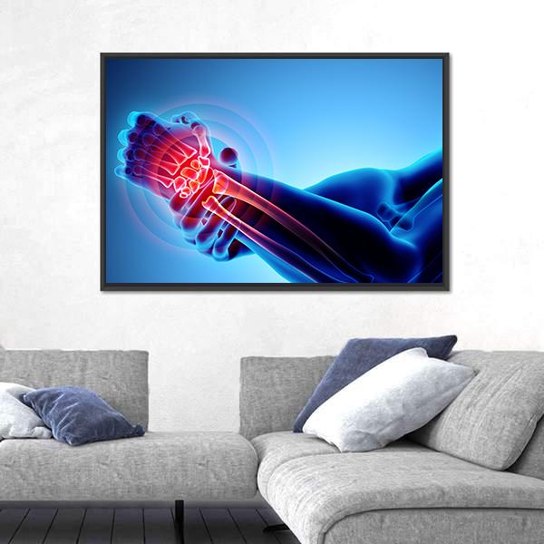 Wrist Painful Skeleton X-Ray Canvas Wall Art-5 Horizontal-Gallery Wrap-22" x 12"-Tiaracle