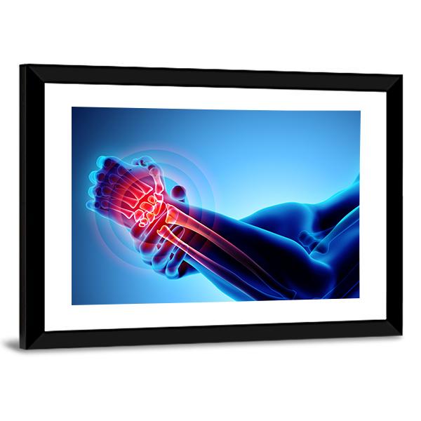 Wrist Painful Skeleton X-Ray Canvas Wall Art-5 Horizontal-Gallery Wrap-22" x 12"-Tiaracle