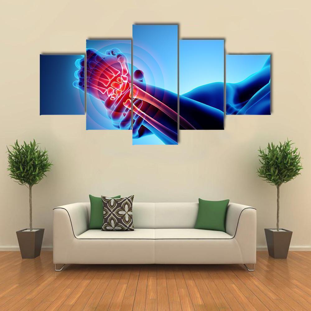 Wrist Painful Skeleton X-Ray Canvas Wall Art-5 Star-Gallery Wrap-62" x 32"-Tiaracle