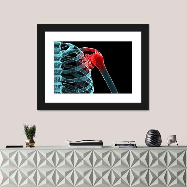 X-Ray Of Painful Shoulder Canvas Wall Art-1 Piece-Framed Print-20" x 16"-Tiaracle