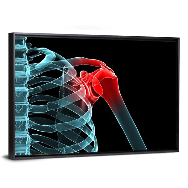 X-Ray Of Painful Shoulder Canvas Wall Art-3 Horizontal-Gallery Wrap-25" x 16"-Tiaracle