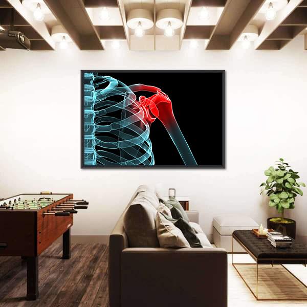 X-Ray Of Painful Shoulder Canvas Wall Art-5 Horizontal-Gallery Wrap-22" x 12"-Tiaracle