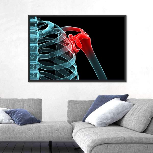 X-Ray Of Painful Shoulder Canvas Wall Art-5 Horizontal-Gallery Wrap-22" x 12"-Tiaracle