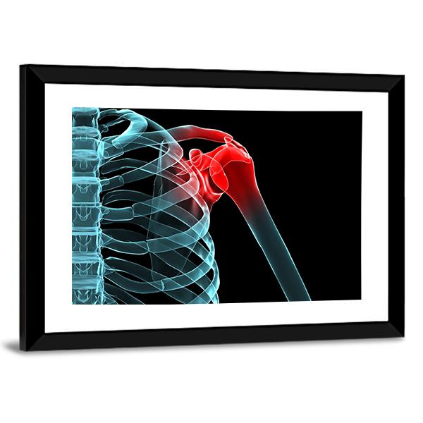 X-Ray Of Painful Shoulder Canvas Wall Art-5 Horizontal-Gallery Wrap-22" x 12"-Tiaracle
