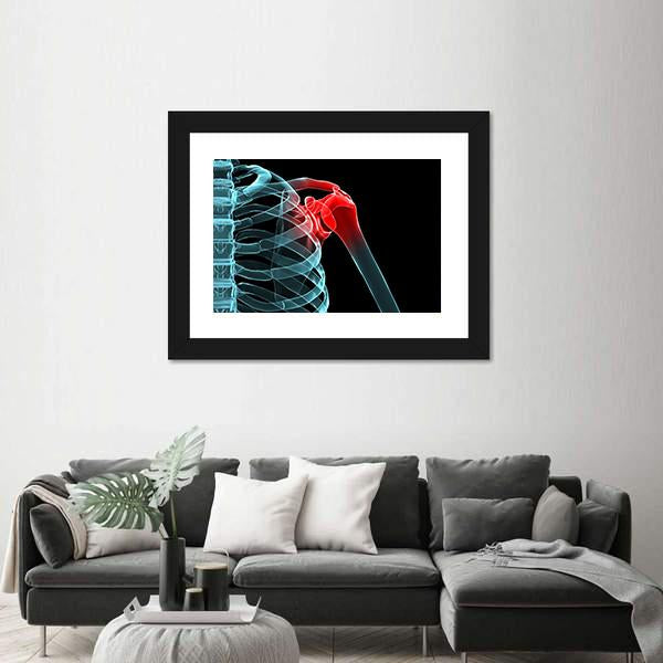 X-Ray Of Painful Shoulder Canvas Wall Art-5 Horizontal-Gallery Wrap-22" x 12"-Tiaracle