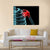 X-Ray Of Painful Shoulder Canvas Wall Art-4 Horizontal-Gallery Wrap-34" x 24"-Tiaracle