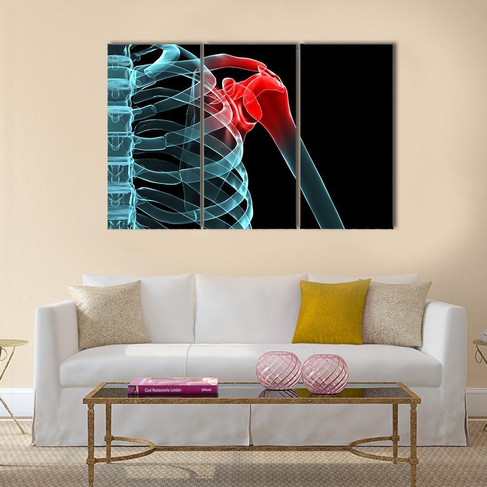 X-Ray Of Painful Shoulder Canvas Wall Art-3 Horizontal-Gallery Wrap-37" x 24"-Tiaracle