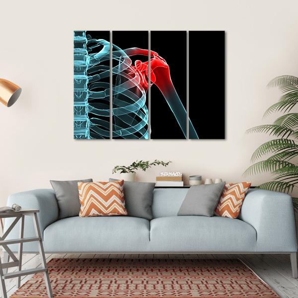 X-Ray Of Painful Shoulder Canvas Wall Art-4 Horizontal-Gallery Wrap-34" x 24"-Tiaracle