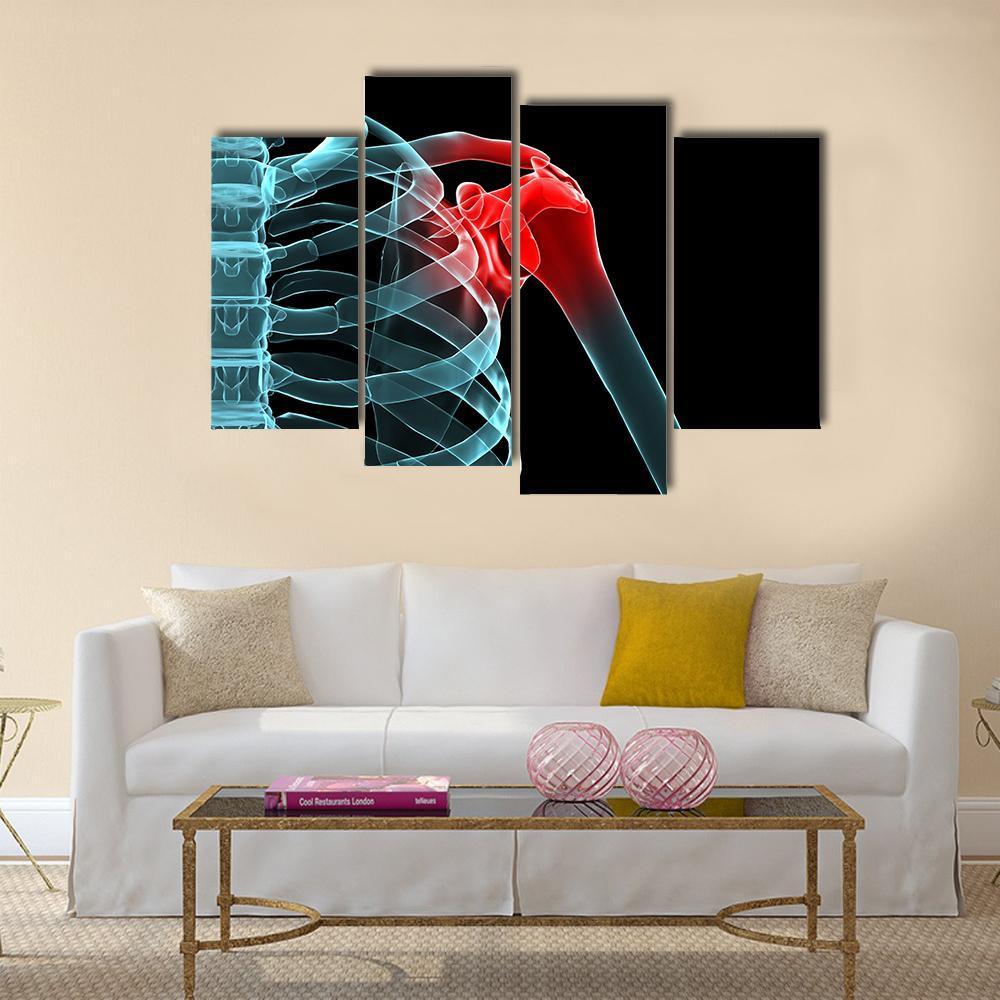 X-Ray Of Painful Shoulder Canvas Wall Art-4 Pop-Gallery Wrap-50" x 32"-Tiaracle