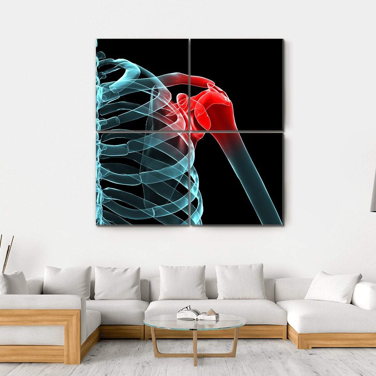 X-Ray Of Painful Shoulder Canvas Wall Art-4 Square-Gallery Wrap-17" x 17"-Tiaracle